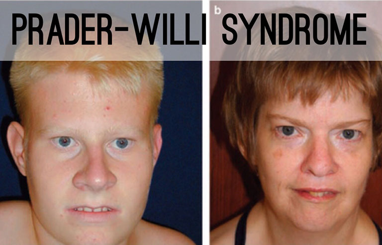 Prader-Willi Syndrome là gì