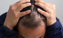stress có thể gây rụng tóc
